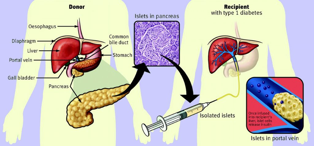 Pancreas Islet Transplant
